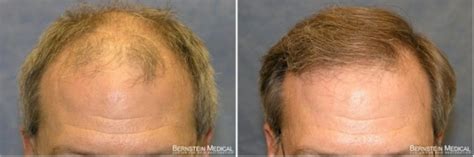 See more ideas about hair loss medication, hair loss, bernstein. Dr Bernstein Hair Transplant Reviews New York Gallery ...