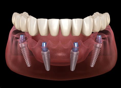 The recovery period for gums to heal varies from individual to individual and also as per the procedure done to extract the tooth. How Long Does It Take Your Gums To Heal After Getting A ...