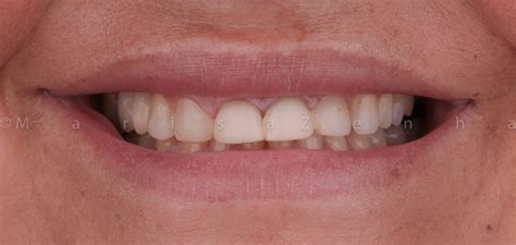 Alguns de nós têm a sorte de nascer com fileiras perfeitas de dentes, mas muitos possuem pelo menos um problema que precisa de correção com a ajuda de aparelhos ortodônticos. Caso 11 - Facetas Dentárias • Clínica Marisa Zenha - Porto