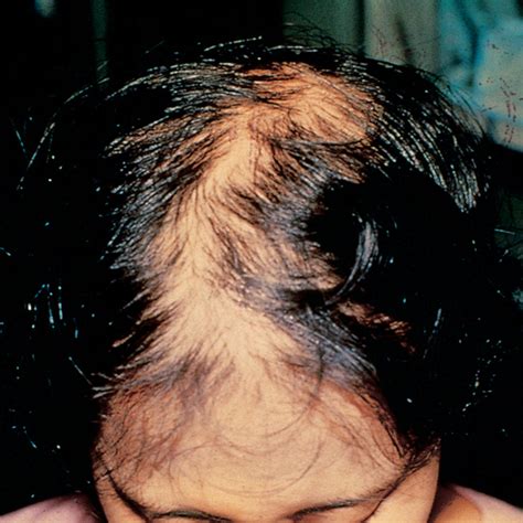 This is the main cause of patchy hair loss that needs medical treatment. Alopecia (Hair Loss), Pediatric | Diseases & Conditions ...