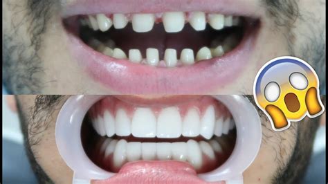 What Happens To Real Teeth Under Veneers - TeethWalls