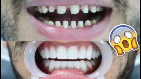 This appliance will virtually look identical to real porcelain veneers and will replace your old smile with a beautiful bright new smile. What Happens To Real Teeth Under Veneers - TeethWalls