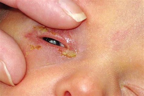 Even a newborn may have pink eyes. How to Get Rid of Pinkeye