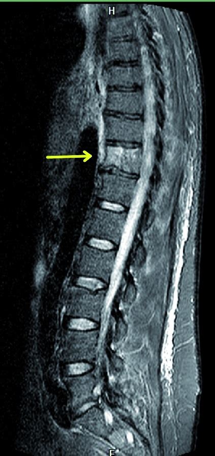 Mrt latest setup mrt v3.95 or v5.43 need dongle(credit service) 2021: Die infektiöse Spondylitis - eine einsatzrelevante ...