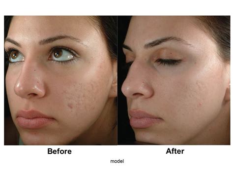 Before applying tretinoin, wash your face using warm water. Dr. Alex's Blog: May 2011