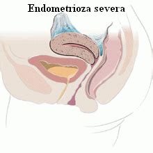 Gościem programu jest ginekolog dr nauk med. 2009-08-07_03 36_endometrioza - Syromed - Clinica ...