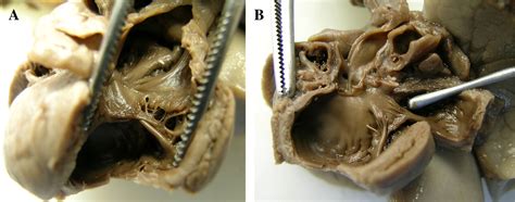 Many people who get myocarditis are otherwise. Human herpes virus 6 causing myocarditis in a fetus: an ...