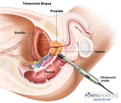 Prostate cancer is very treatable, especially when caught early. Prostate Cancer Treatment in Ahmedabad | Prostate Cancer ...