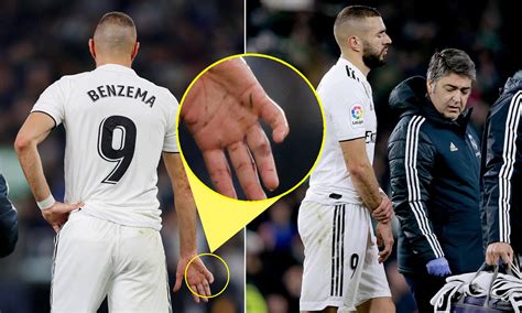 In karim's recent picture we can see what appears to. Zašto Benzema uvijek igra s bandažom na desnoj ruci ...
