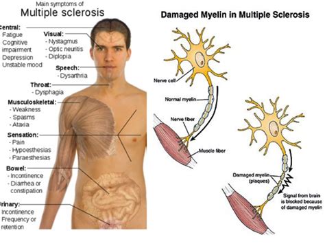 Symptoms of multiple sclerosis may be single or multiple. Pathophysiology and clinical presentation - correct ...