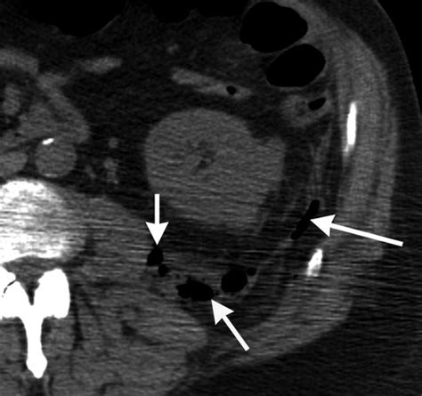 Check spelling or type a new query. Fournier Gangrene: Role of Imaging | RadioGraphics