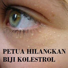 Biji kolesterol berpunca daripada kandungan minyak yang banyak pada kulit muka. Rak Vitamin Cergas: Pertua Hilangkan Biji Kolestrol