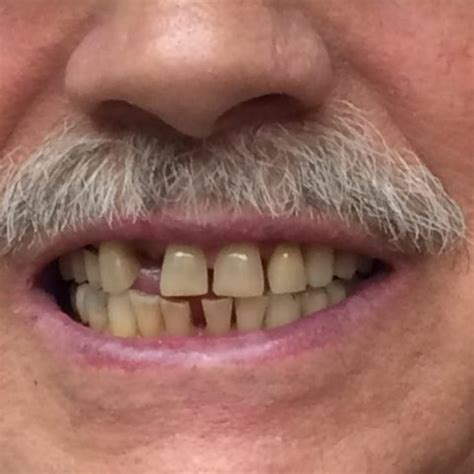 Due to changes in the gums and bone following tooth extraction and healing, immediate dentures may require relining or replacement to fit properly. Before & After Pictures | Brookswood Denture Clinic