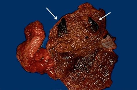 Gunshot wounds can be particularly devastating compared to other penetrating injuries because the trajectory and fragmentation of bullets can be unpredictable after entry. Forensic Pathology