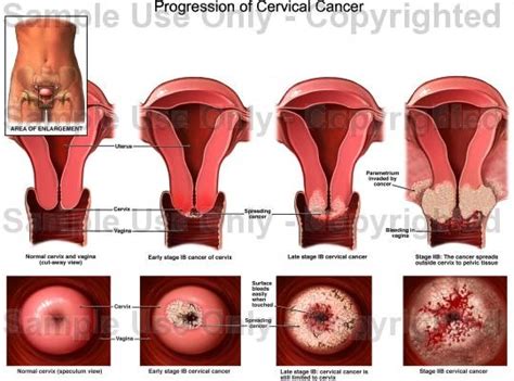 Papsmear merupakan salah satu prosedur pemeriksaan pada leher rahim pada wanita. PAP SMEAR | Papanikolaou Test