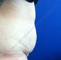 L'abdominoplastie ou dermolipectomie de l'abdomen peut apporter une solution à votre besoin. Abdominoplastie Marseille, Plastie abdominale - Dr Gonnelli