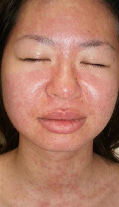 13) banerjee i., mondal s., sen s. Skin rash in a patient with infectious mononucleosis | BMJ ...