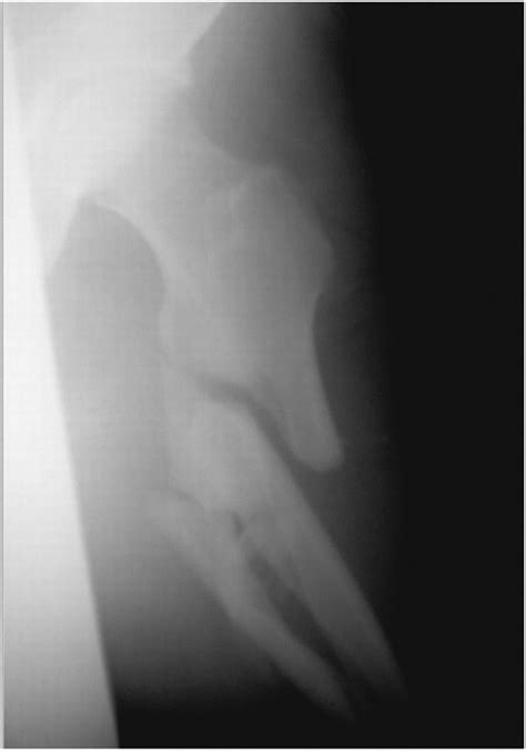 Subtrochanteric Fractures - TeachMe Orthopedics