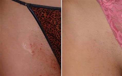 If you are planning on undergoing laser hair removal, you should limit plucking, waxing, and electrolysis for six weeks before treatment. Before & After Pictures - Dermalaser Med Spa