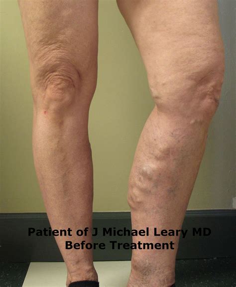 This area should be qualified and validated before starting its use. Varicose Vein exam Orange County | Dr. Michael Leary