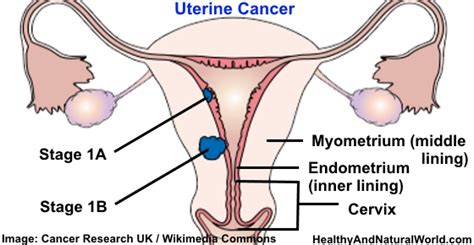 Womb cancer has several different names. Uterine (Endometrial) Cancer - Symptoms, Risk Factors and ...