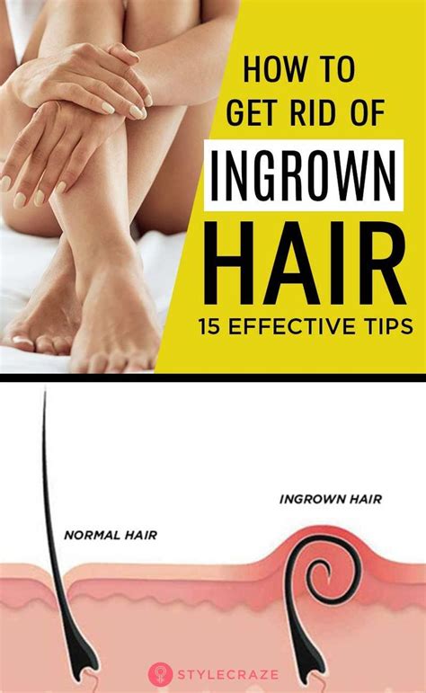 According to the nhs an ingrown hair can occur when the hair follicle becomes clogged with dead skin cells. How To Get Rid Of Ingrown Hair: Face, Bikini Area, Legs ...