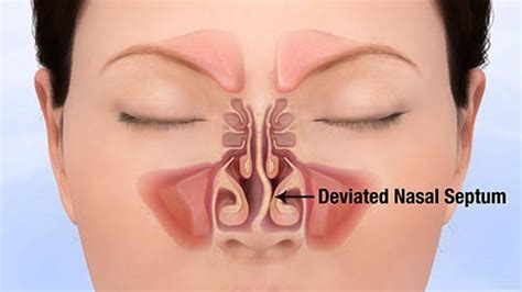 Deviated septum, as a medical condition, generally only refers to severely displaced septums. How does a surgeon fix the deviated nasal septum in a ...