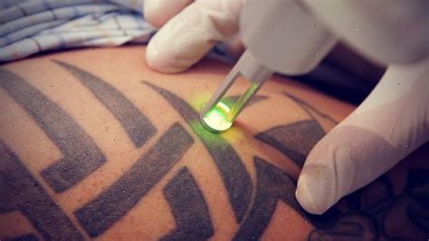 Welcome to the largest affiliate network in the nordics. Tattoo Removal Hamilton - Tatto Pictures