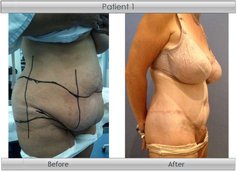 Body Lift Before and After | Dr Quinn Plastic Surgery Perth