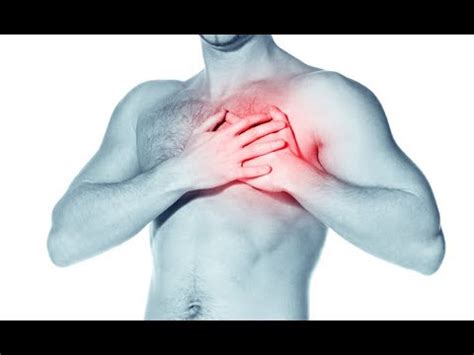 Prinzmetal's angina, also known as variant angina or angina inversa, is a syndrome typically consisting of angina (cardiac chest pain) at rest that ecg finding will more often show st segment elevation than st depression. Prinzmetal's Variant Angina - YouTube
