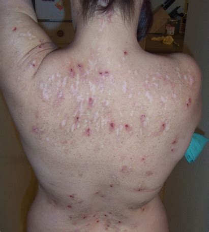 Morgellons disease is a rare condition. Morgellons patient's back. Note that lesions and scars ...