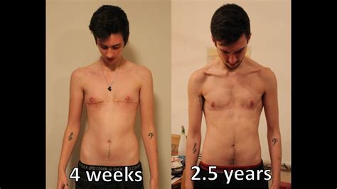 Dr gallagher will choose the best procedure for your body type with you. FTM Transgender: 2.5 years post op top surgery update and ...