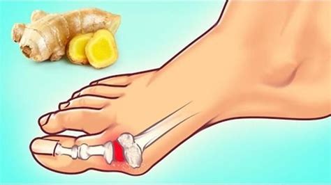 専門家がすすめる痛風をやっつける10の方法. | Gout attack, Gout, Gout ...