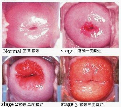 Any vaginal bleeding after menopause should be brought to your doctor's attention right away. Cervical most cancers causes Bleeding - broksityblog