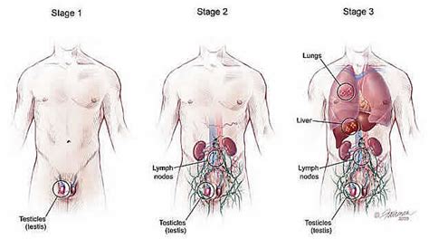 A lump or swelling in your neck. Testicular Cancer: Treatment Options for Stages and Type ...