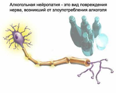 Полинейропатия алкогольная диета Алкогольная полинейропатия рук и нижних конечностей: симптомы и лечение Алкогольная полинейропатия рук и нижних конечностей: симптомы и лечение Полинейропатия алкогольная диета