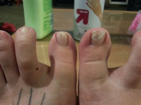 A series of images of covid toes, photographed by italian dermatologist andrea bassi and posted on twitter show the range of appearances this rash can take. Took off my toenail polish and now have weird white marks only where the polish was. It's not ...