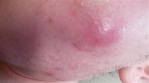 Vielmehr spielen stress, hormonelle veränderungen oder erkrankungen eine rolle. Komische pickel abzesse geschwulzt im gesicht? (Beule)