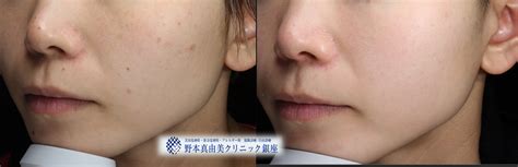 ゼオスキンヘルスと一緒にほくろも｜野本真由美クリニック銀座