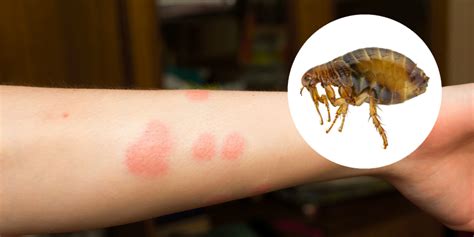 Muggen steken hun lange slurf in de menselijke huid en afgifte van speeksel. Negen veelvoorkomende insectenbeten waar je deze zomer ...