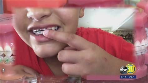 Maybe you would like to learn more about one of these? DIY braces becoming a troubling dental trend among kids and young people - ABC30 Fresno