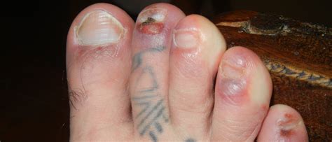What can you do to fix a blood blister? How to Care for Your Feet When Traveling Tip