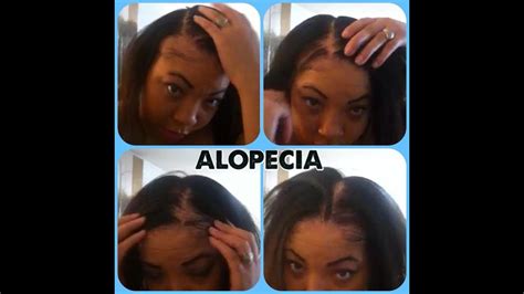 Other studies have ascertained that free radical damages may be one of the larger contributors to the lack of hair growth in many subjects. ALOPECIA!! Hair loss, Ovarian Cyst sufferer, No edges ...