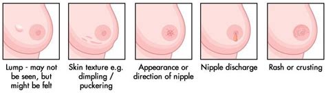 When a cancer grows within the breast, it distorts the normal architecture of the breast tissue, which can then distort the look of the overlying breast skin. Here Is All That Every Woman Needs To Know About Breast Cancer