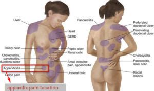 The painful spot is tender to touch and abdominal wall above the appendix is rigid. Healthoolappendix pain location | Healthool