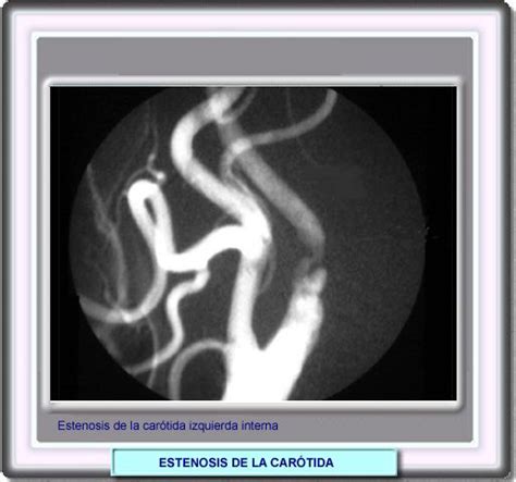 Focal cerebral ischemia (fci) is often results from a blood clot in the brain. ATLAS DE NEUROLOGIA