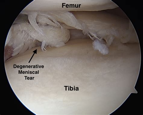 The pain is mainly during squatting or movements in which the knee is completely folded (flexed). Do Degenerative Meniscal Tears Require Surgery? - Jeffrey ...