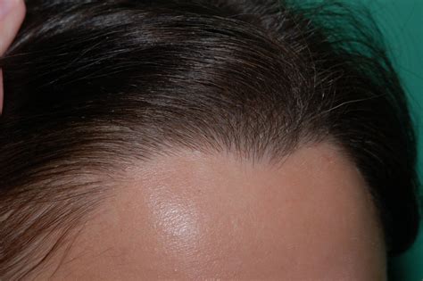 Insurance never covers hair restoration regardless of the cause, says yates. Hair Loss Treatment for Women Chicago, IL - Chicago Hair ...