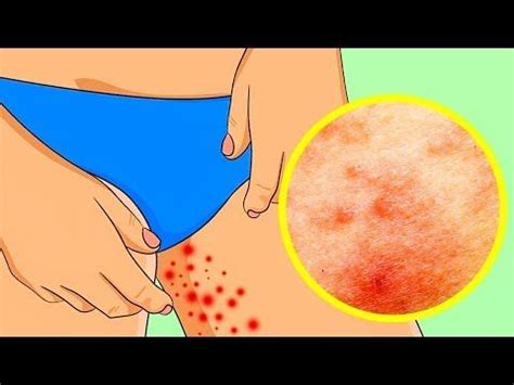 YouTube | Get rid of eczema, Summer makeup, Eczema
