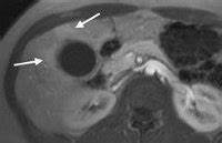 Диета при хроническом бескаменном холецистит Хронический бескаменный холецистит :: Симптомы, причины, лечение и шифр Хронический бескаменный холецистит :: Симптомы, причины, лечение и шифр Диета при хроническом бескаменном холецистит
